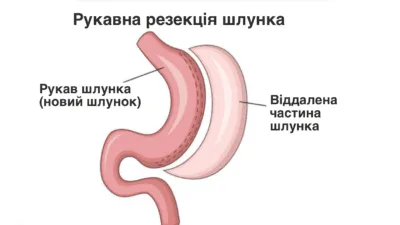 Передовий метод лікування діабету зменшенням шлунка лапароскопічним методом