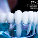Огляд на імплантацію зубів